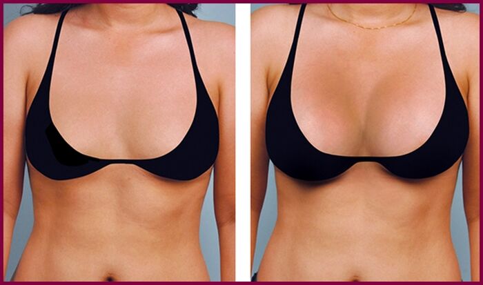 vor und nach einer fetten Brustvergrößerung