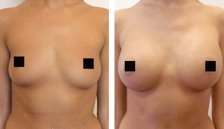 Brüste vor und nach Hyaluronsäure-Augmentation