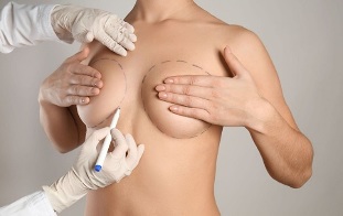Brustvergrößerungsmethoden mit Operation