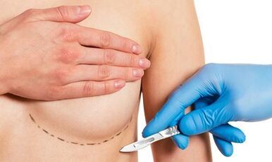 Submammatrischer Zugang zur Brustvergrößerung mit Implantaten